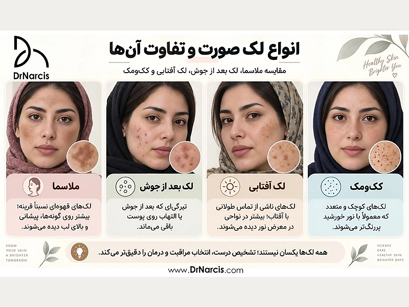 انواع لک صورت و تفاوت آنها